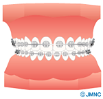 ブラケット矯正