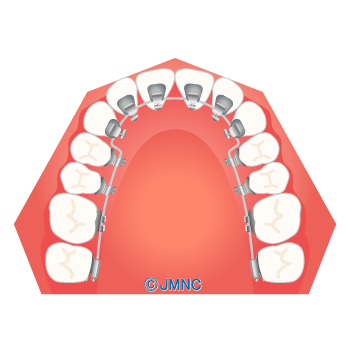 リンガル（舌側）矯正