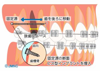 インプラント矯正