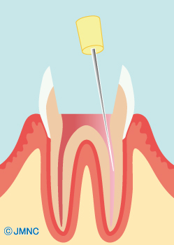根管治療